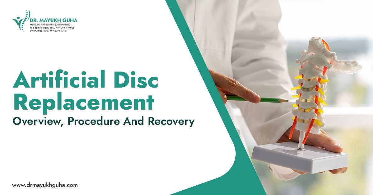Artificial Disc Replacement: Overview, Procedure, and Recovery