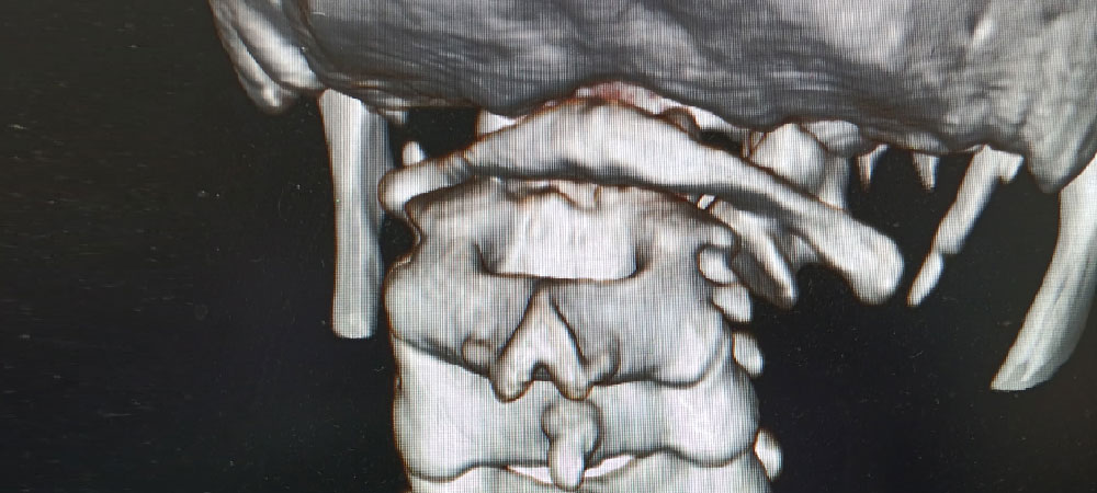 Craniovertebral Junction (CVJ)
