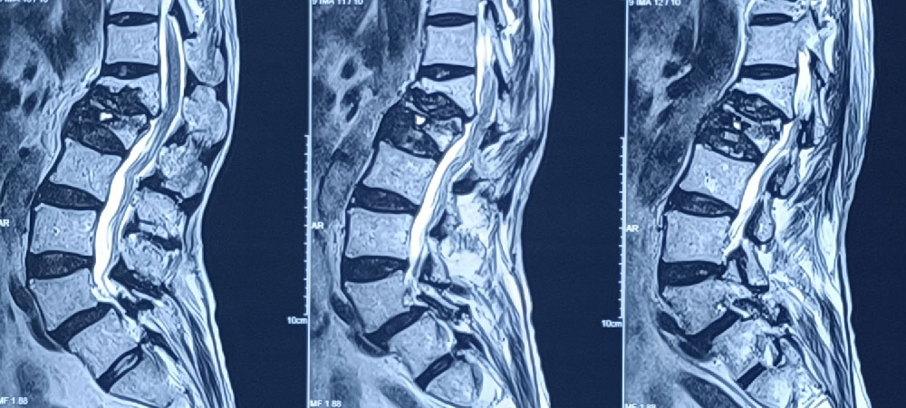 Osteoporosis & Osteoporotic Fracture